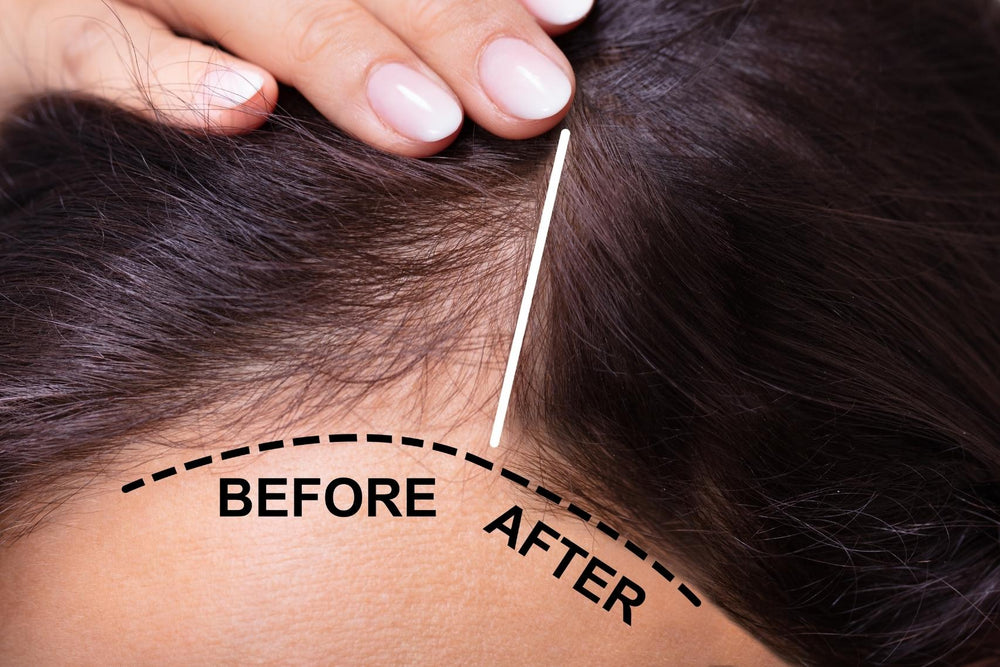 HAIRMETTO before and after hair restoration KIT with derma roller. Stimulate follicles, block DHT, 24/7 protection and scalp treatment, nourish follicles, topical saw palmetto formula