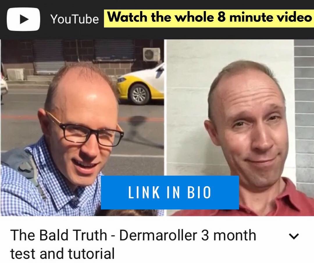 the Bald Truth watch a Dermaroller tutorial 3 month test