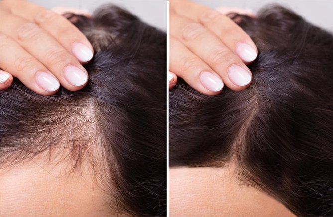 Tratamiento para la caída del cabello en mujeres