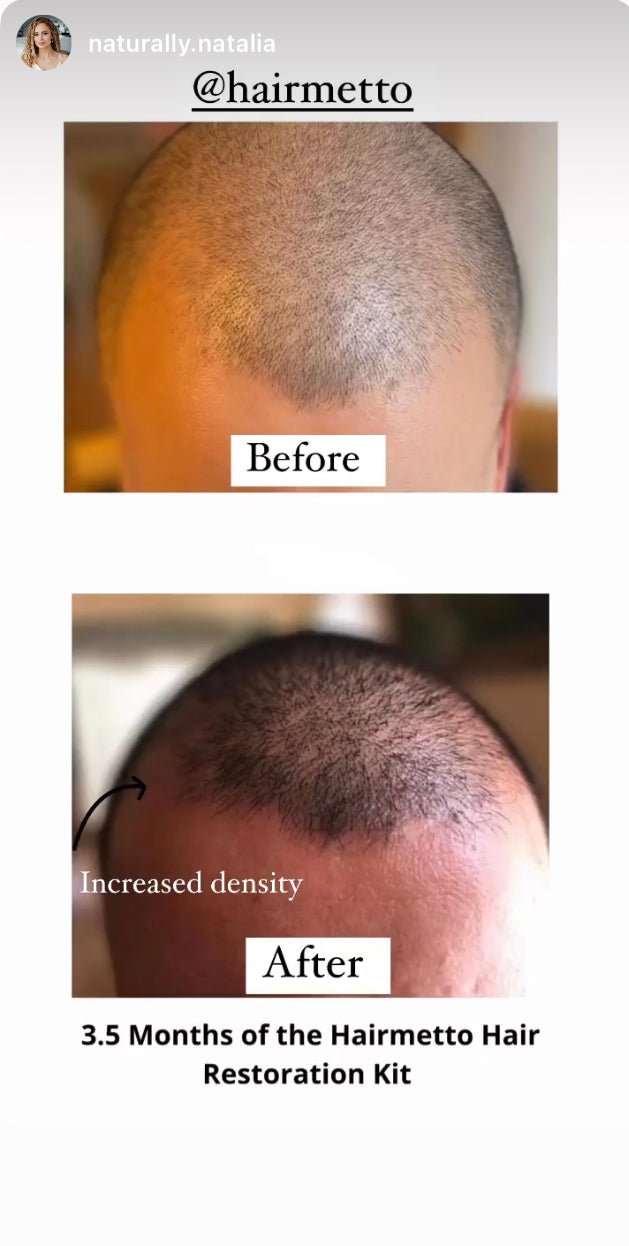 HAIRMETTO before and after with hair restoration KIT with derma roller. Stimulate follicles, block DHT, 24/7 protection and scalp treatment, nourish follicles, topical saw palmetto formula